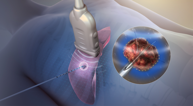 Transcutaneous Electrical Nerve Stimulation in Physical Therapy