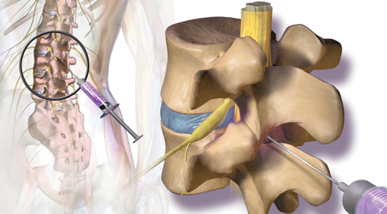 Transcutaneous Electrical Nerve Stimulation in Physical Therapy