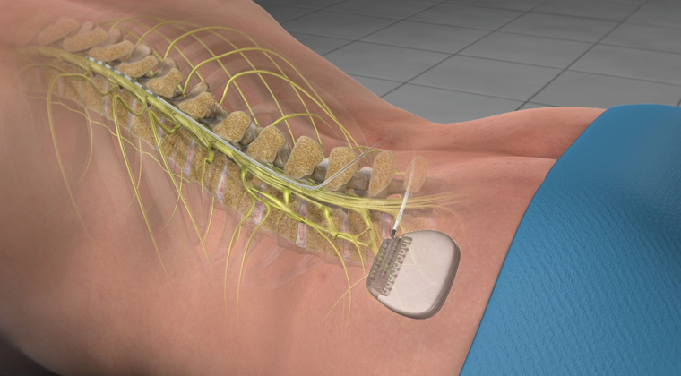 spinal stimulation graphic 